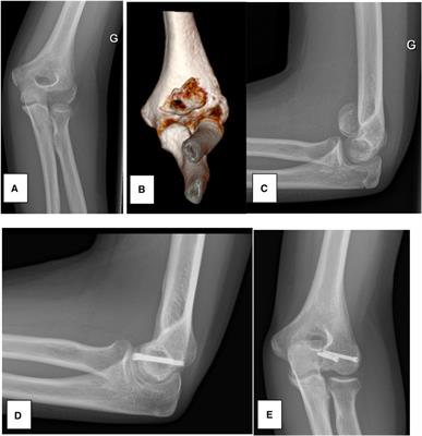 Shear fractures of the capitellum in children: a case report and narrative review